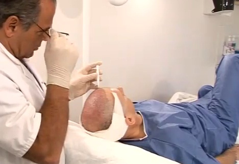 Le mystère de la calvitie enfin élucidé ? (VIDEO)