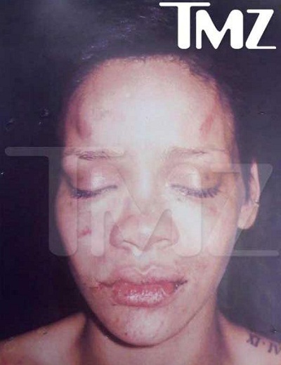 Rihanna : nouvelles photos chocs après son agression par Chris Brown (PHOTOS)