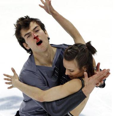 Eric Radford nez cassé