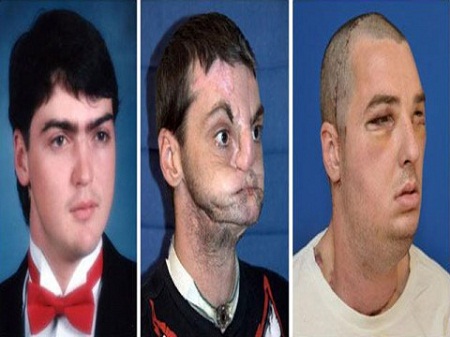 USA : La greffe du visage la plus complète réussie à ce jour (VIDEO)