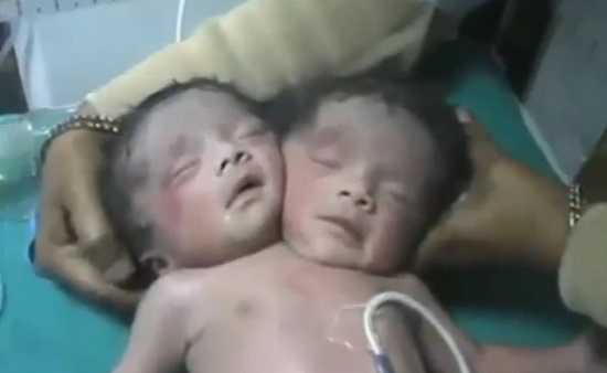 Naissance d’un bébé à deux têtes en Inde (VIDEO)