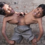 Inde : deux frères siamois refusent de se séparer (VIDEO)