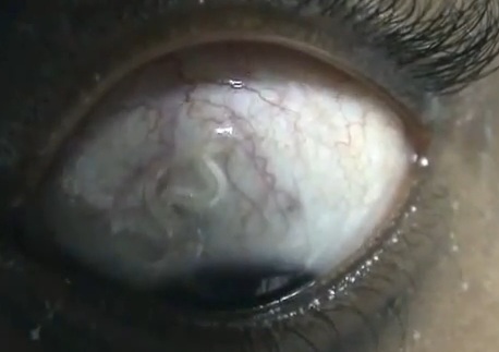 Choc : elle a un asticot vivant dans l’oeil (VIDEO)