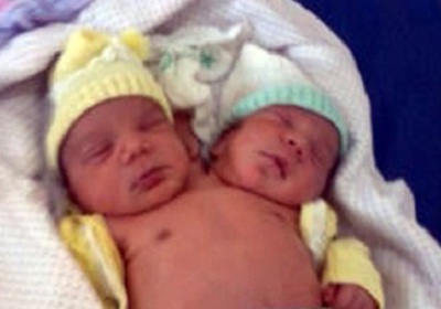 Naissance d’un bébé à 2 têtes au Brésil (VIDEO)