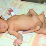 Pakistan : naissance d&rsquo;un bébé à 6 jambes (VIDEO)