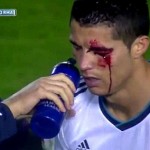 Réal : L&rsquo;oeil ensanglanté de Ronaldo (VIDEO)