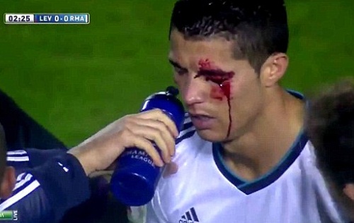 Réal : L&rsquo;oeil ensanglanté de Ronaldo (VIDEO)