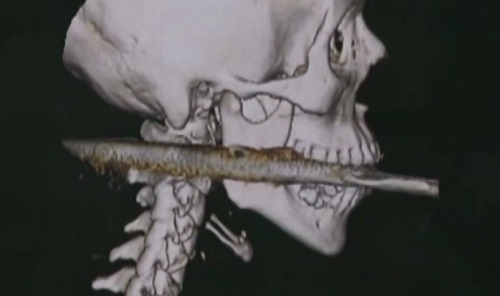 Elle survit à un harpon dans le cou (VIDEO)