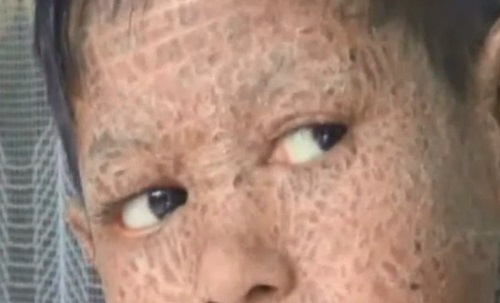 L&rsquo;enfant à la peau de serpent (VIDEO)