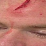La grosse blessure au front de Wayne Rooney (PHOTOS ET VIDEO)