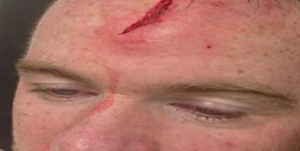 La grosse blessure au front de Wayne Rooney (PHOTOS ET VIDEO)