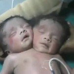 Naissance d&rsquo;un bébé à deux têtes en Inde (VIDEO)