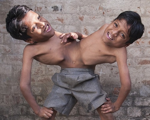 Inde : deux frères siamois refusent de se séparer (VIDEO)