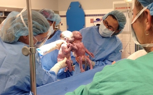 Des jumelles naissent en se tenant la main (VIDEO)