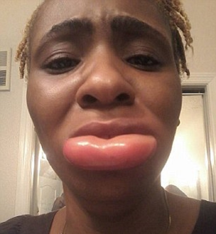Sa lèvre triple de volume après avoir utilisé un rouge à lèvres (photos et vidéo)